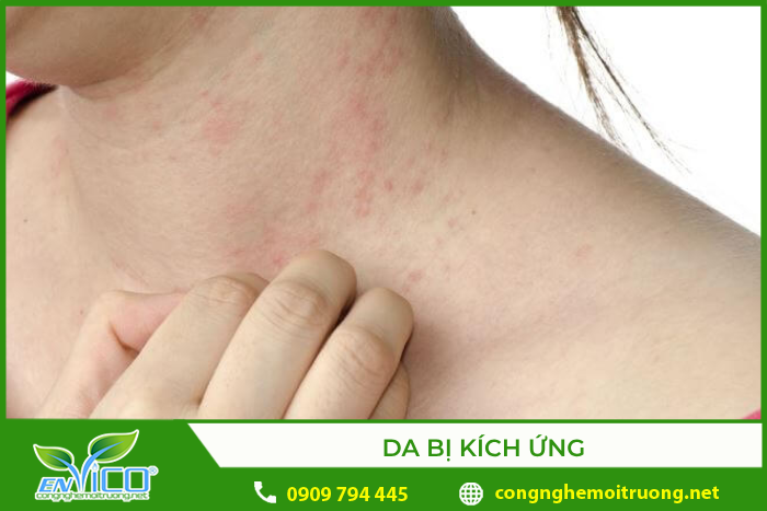 Da bị kích ứng mẩn ngứa khi tiếp xúc với nước mưa